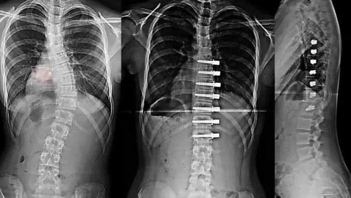 Stretching Method in Scoliosis Surgery – Tethering