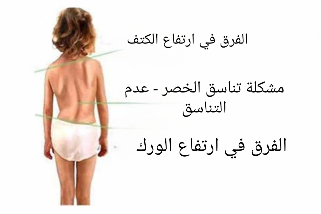 مشاكل العمود الفقري لدى الأطفال